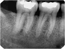 Răng chết tủy 2