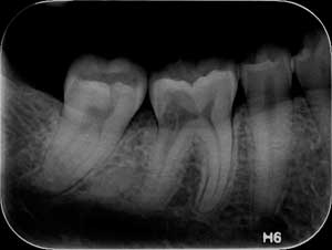 endodontics, internal resorption, resorption, diagnosis