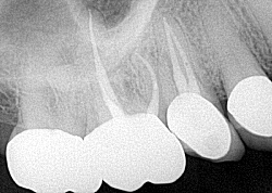 endodontics, cracked tooth, fractured tooth, root canal
