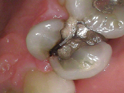endodontics, cracked tooth, fractured tooth, root canal